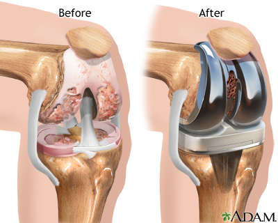 Top 5 Mistakes After Knee Replacement